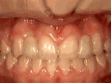 Close-up of misaligned teeth requiring orthodontic treatment