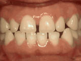 Close-up of teeth with clear orthodontic braces