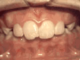Close-up of adult front teeth with misalignment