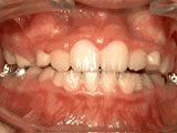 Close-up of teeth with dental braces.