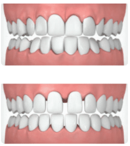 Healthy teeth before and after alignment