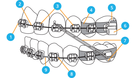 Diagram of orthodontic braces and wiring sequence