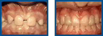 Before and after dental alignment treatment photos