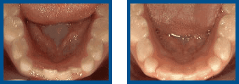 Close-ups of healthy gums and teeth in two expressions