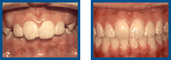 Before and after teeth straightening treatment photos