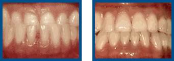 Before and after teeth whitening comparison.