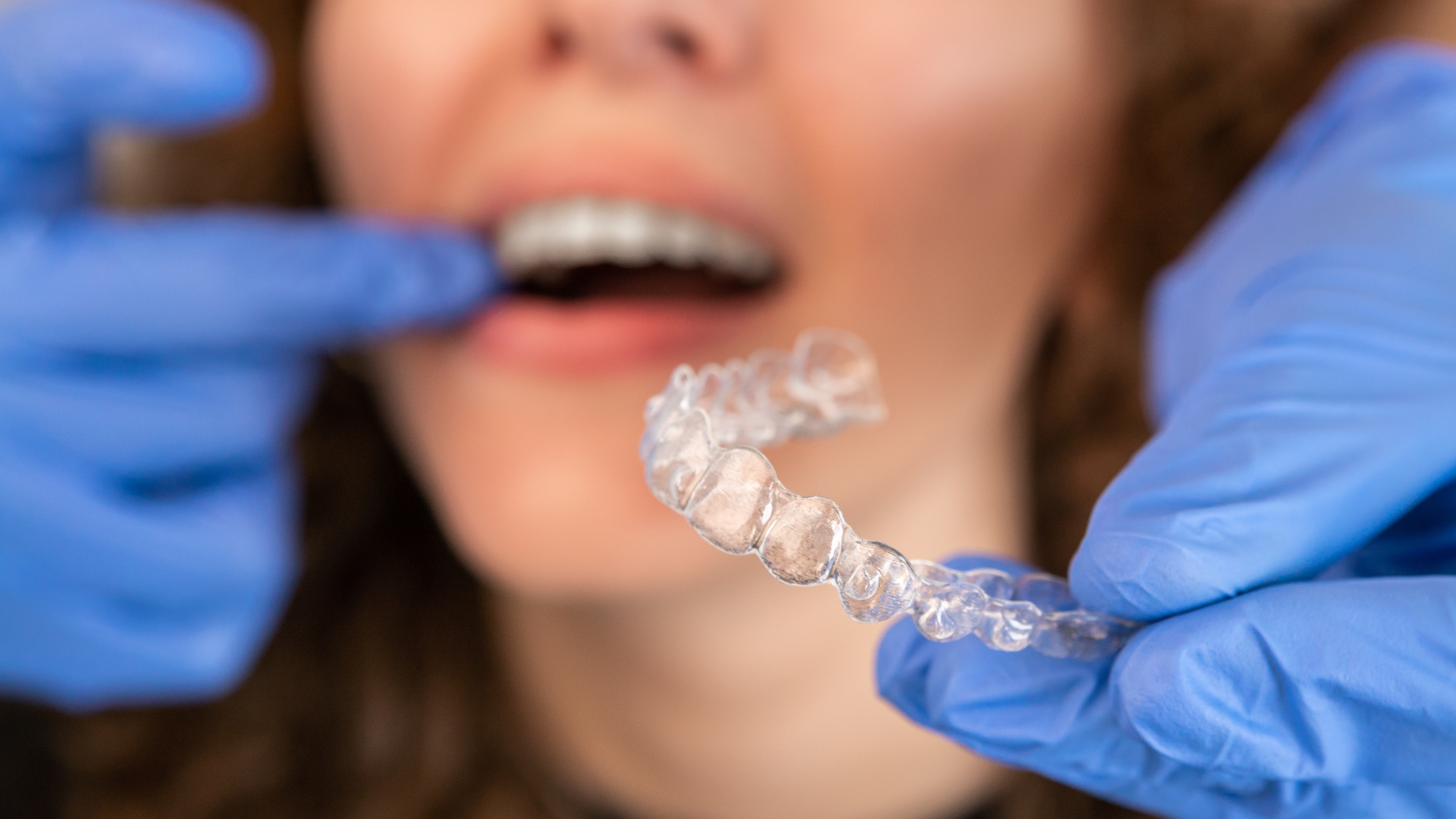 Invisalign costs in roseville ca